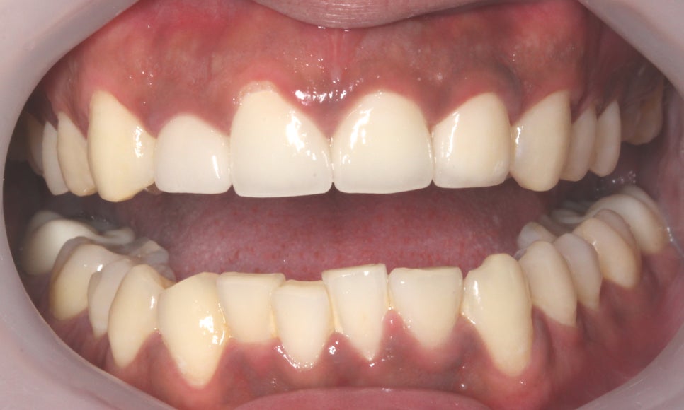 평생 소장! 앞니보철은 자연스러운 2D치과(투디치과) BLINX(블링스)로! 관련 이미지 4