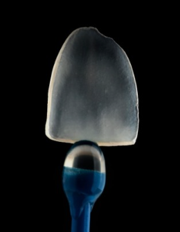 치아성형은 치아삭제 없는 무삭제 라미네이트 블랙필름 관련 이미지 8