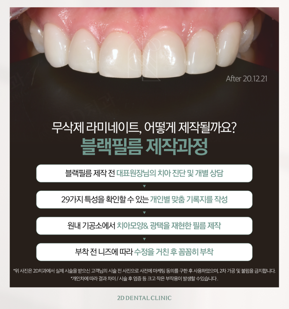 튼튼하면서도 자연스럽게, 치아무삭제라미네이트 앞니성형 관련 이미지 5
