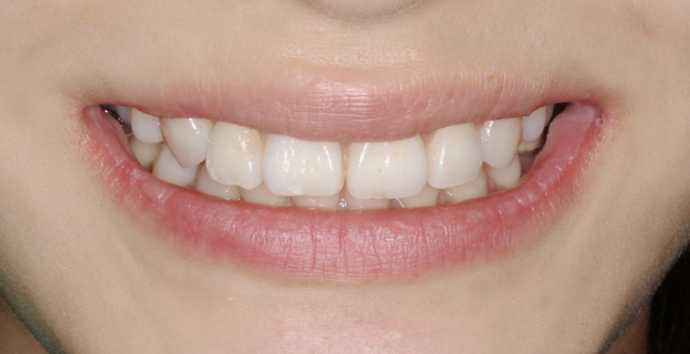 교정일기:앞니 부분 블링스(라미네이트) 심리보철 진료과정 후기 관련 이미지 2