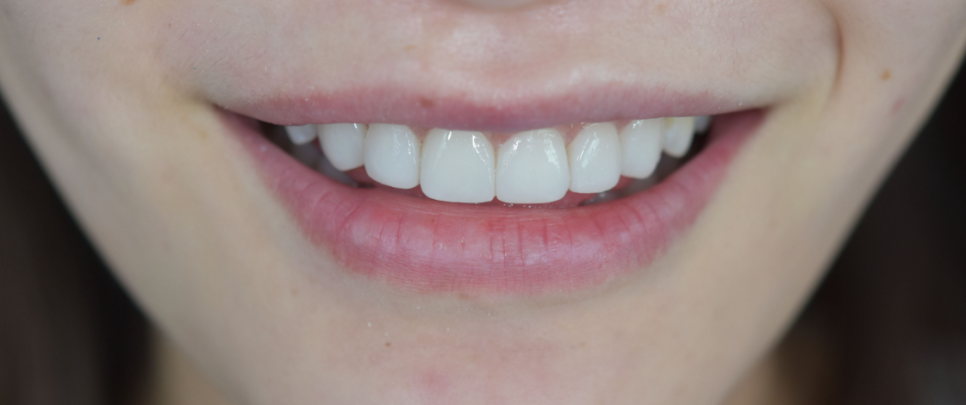 라미네이트치과 알아본다면? 관련 이미지 1