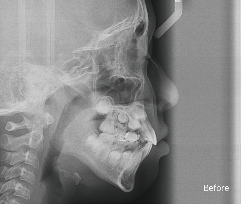 어린이 반대교합 덧니 교정으로 교정 끝! by. 투디치과(2D치과) 관련 이미지 12
