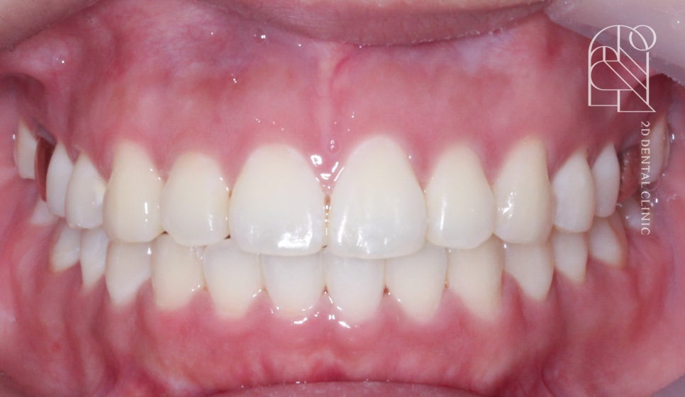 부정교합 치아교정, 전체교정으로 완성하기! by. 투디치과(2D치과) 관련 이미지 7