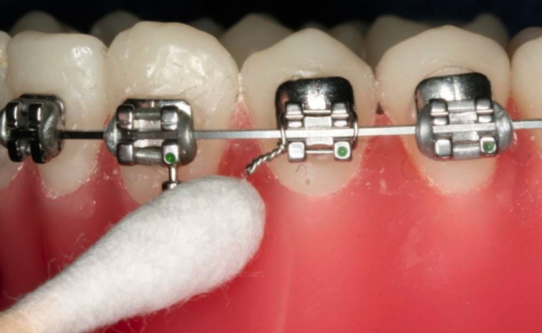 [투디(2D)치과] 데이먼 클리어 교정에 대해 알아보자! 관련 이미지 5