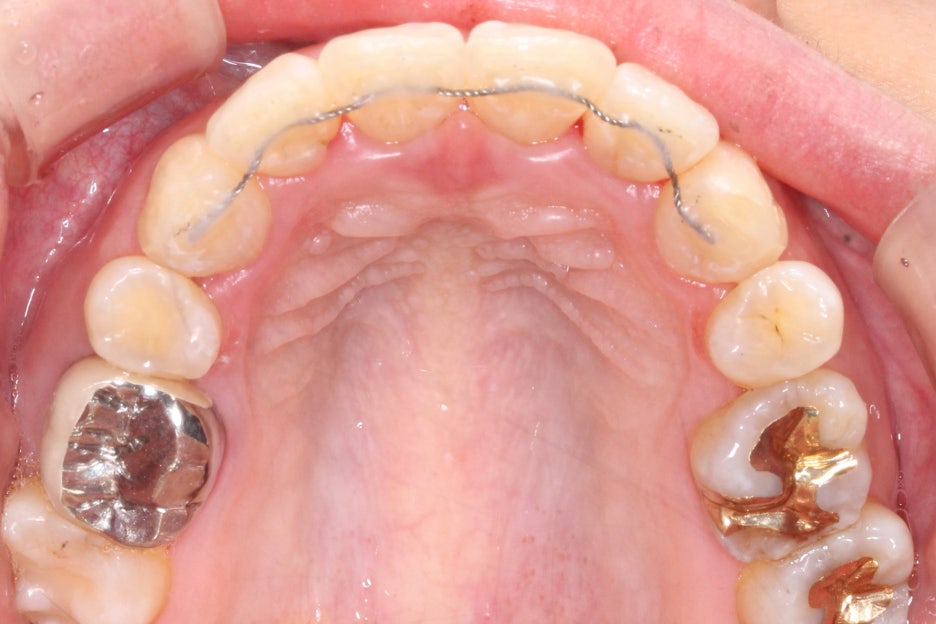 토끼앞니교정 부분교정으로 단기완성 관련 이미지 11