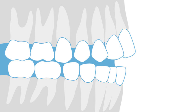 개방교합, 교정으로 잇몸질환 예방하자! 관련 이미지 1