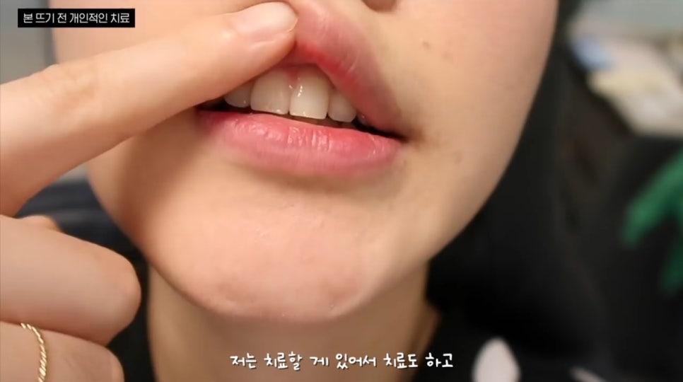 무삭제 라미네이트, 쎄라필름(TheraFilm)후기_유튜버Coco Riley님 by.2D치과(투디치과) 관련 이미지 4