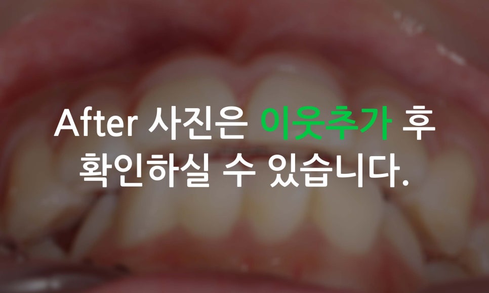 앞니틀어짐, 삐뚤어진 앞니를 부분교정하는 방법 관련 이미지 11