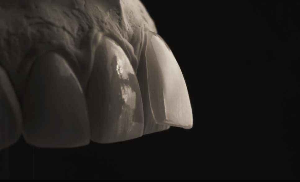 무삭제 라미네이트잘하는곳 잘 찾는 법! 관련 이미지 5