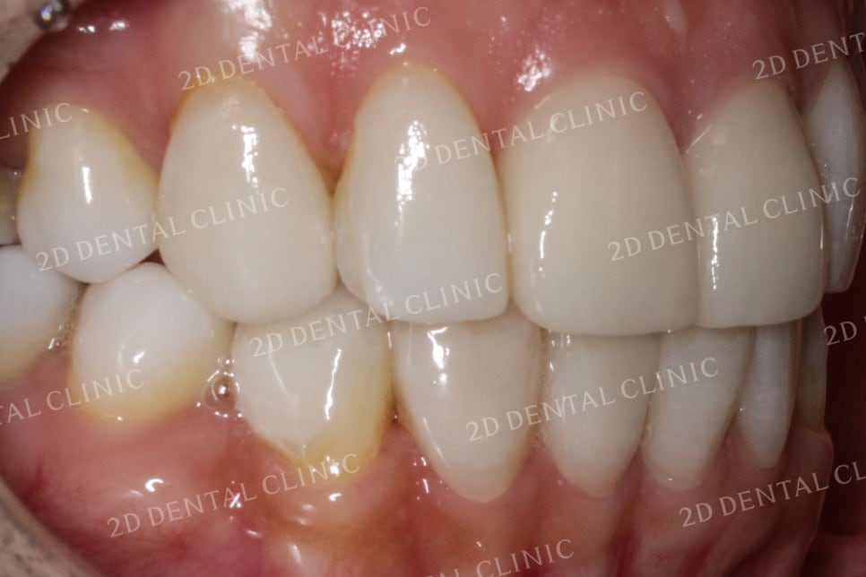 치아틈새를 완벽하게 메꾸자! 블랙트라이앵글 쎄라필름으로 완전 삭제! by.투디치과(2D치과) 관련 이미지 16