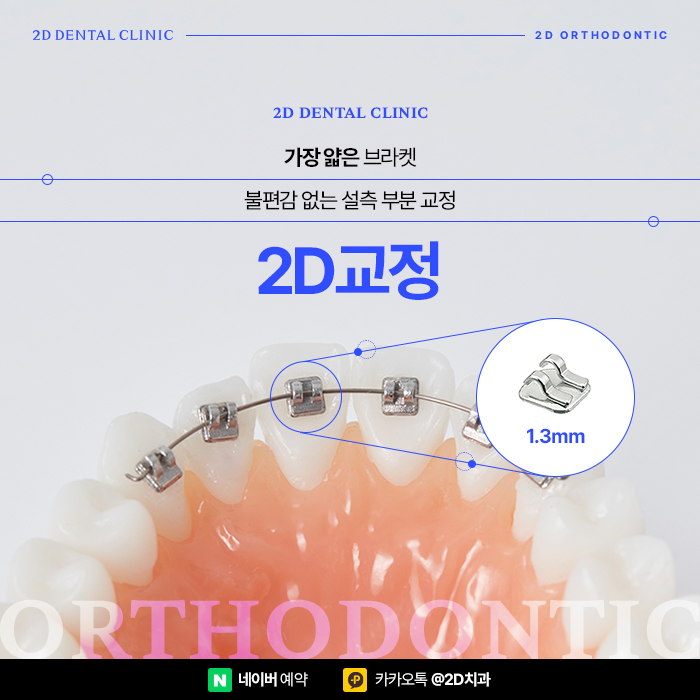 치아발치 때문에 치아교정 망설이신다면 신논현역 2d교정 관련 이미지 1