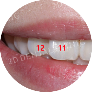 돌출입, 돌출앞니를 부분교정으로 고르게! by.투디치과(2D치과) 관련 이미지 8