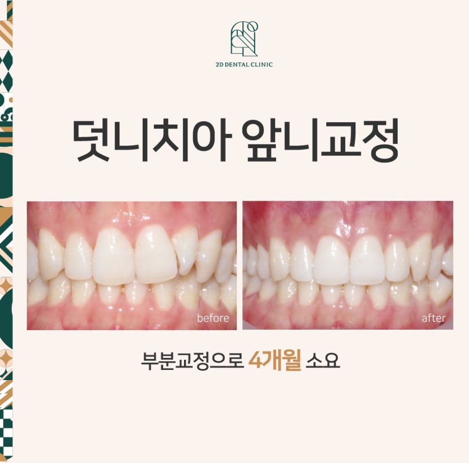 덧니치아 앞니교정 4개월 교정 완료! by. 투디치과(2D치과) 관련 이미지 1