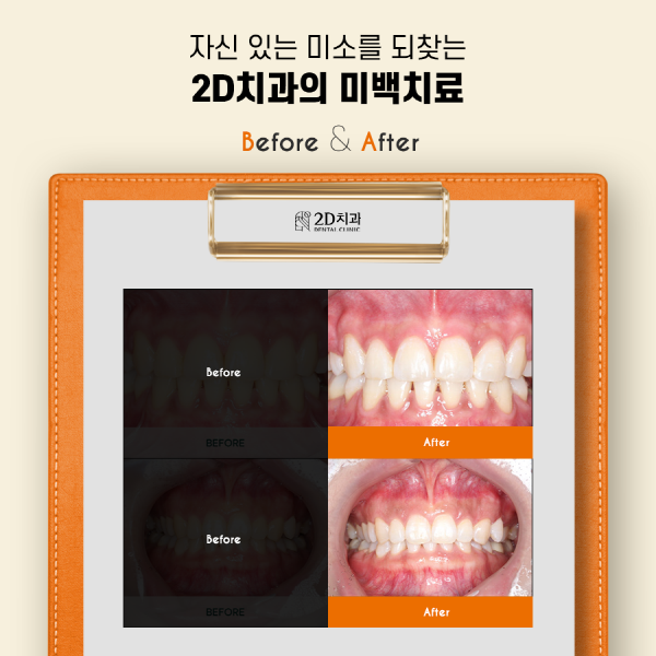 치아착색음식 때문? 양치해도 치아가 누런 이유 관련 이미지 7