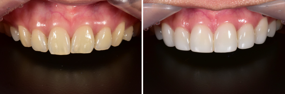무삭제블랙필름 실제 후기 관련 이미지 4