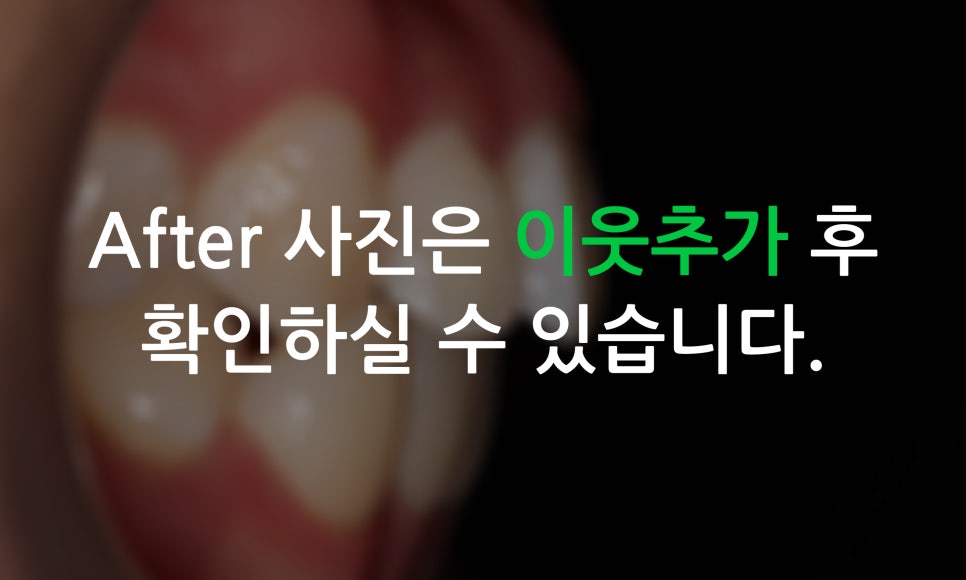 나비앞니 교정, 투디교정으로 빠르게 완성하는 방법! 관련 이미지 8
