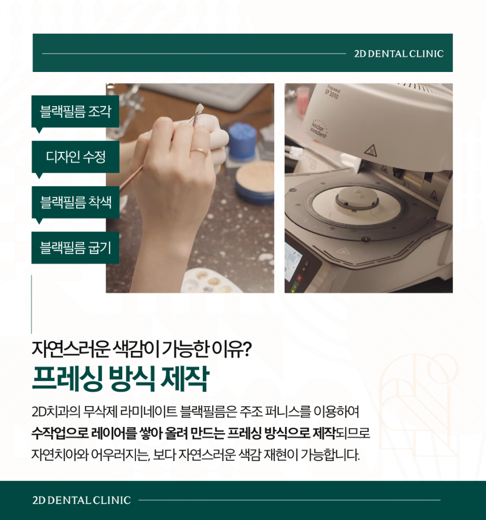 인천무삭제라미네이트 앞니치아변색 커피 먹고 누런 이 다시 하얗게 관련 이미지 5