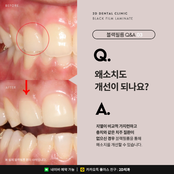 무삭제 라미네이트 <블랙필름> 이 궁금하다면? 관련 이미지 5