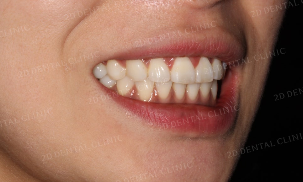 [부분교정] 틀어진 앞니, 부분교정으로 앞니교정하기! by.투디치과(2D치과) 관련 이미지 15