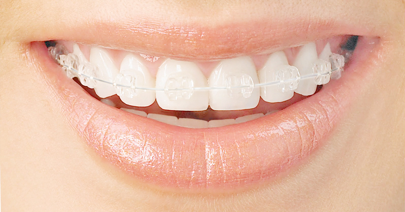 [투디(2D)치과] 순수교정, 화이트 와이어와 미백의 만남 관련 이미지 2