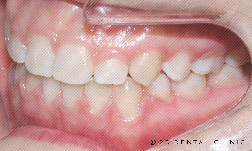 절단교합 교정 케이스 전후비교, 교정전문 2D치과 관련 이미지 15