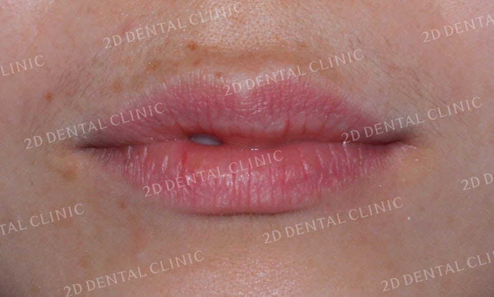 [투디교정] 덧니교정, 앞니교정으로 치열을 고르게! by.투디치과(2D치과) 관련 이미지 2