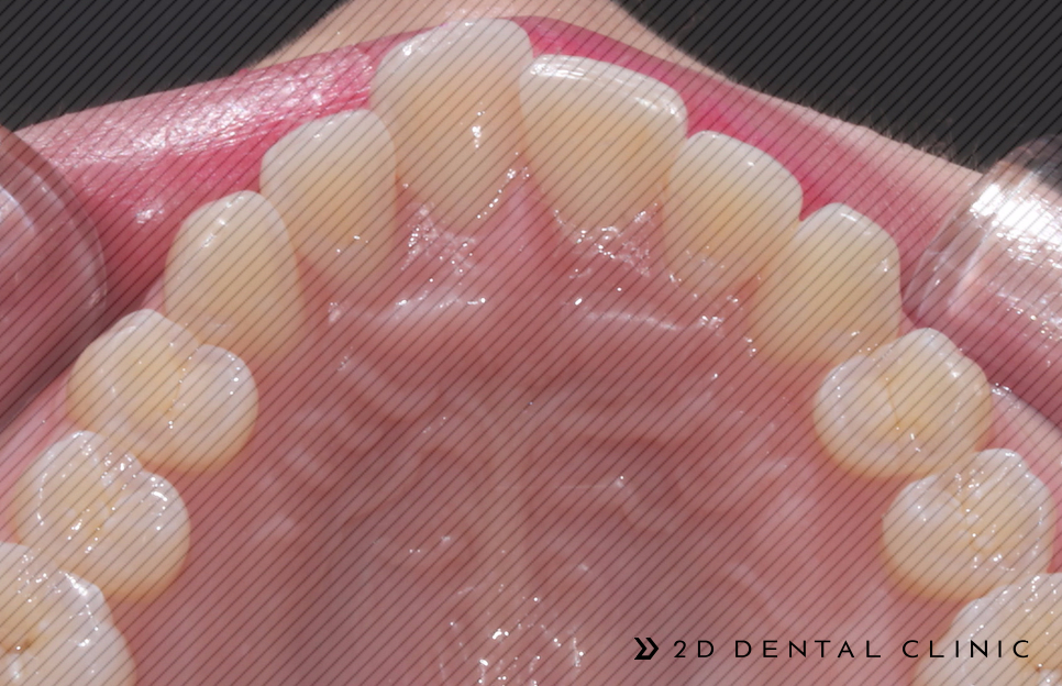 앞니 덧니 부분교정 케이스 전후비교, 교정전문 2D치과 관련 이미지 10