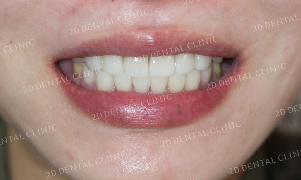 누렇고 손상된 치아를 밝고 가지런하게! by. 투디치과(2D치과)_블링스 시술후기 관련 이미지 4