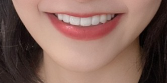 거미스마일 잇몸성형 강남라미네이트 2D치과 관련 이미지 3