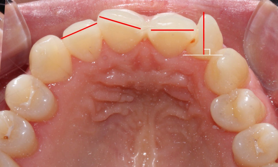 앞니틀어짐 2D교정으로 한번에 끝내는 방법! 관련 이미지 5