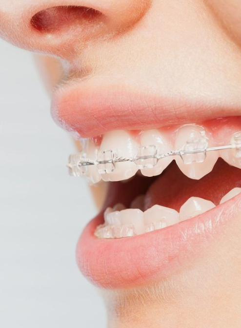 치아성형은 치아삭제 없는 무삭제 라미네이트 블랙필름 관련 이미지 5