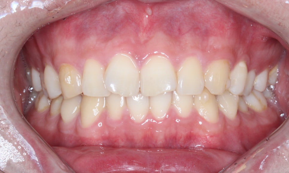 나비치아교정! 15개월만에 빠른 교정 by.투디치과(2D치과) 관련 이미지 4