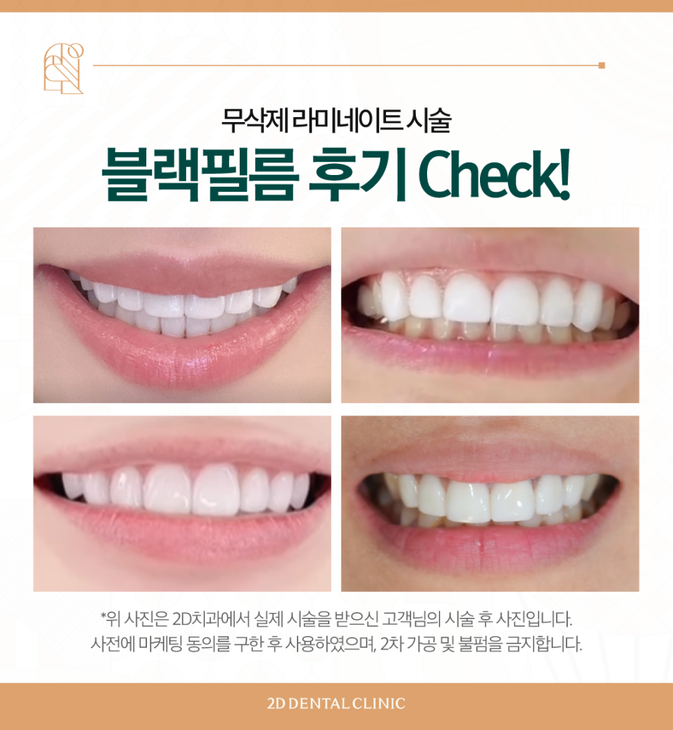 라미네이트 무삭제블랙필름 치아변색 고민, 해결은? 관련 이미지 8