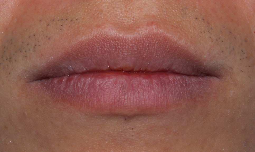 뻐드렁니 교정, 강남역치과에서 앞니 부분 교정한 후기! 관련 이미지 2