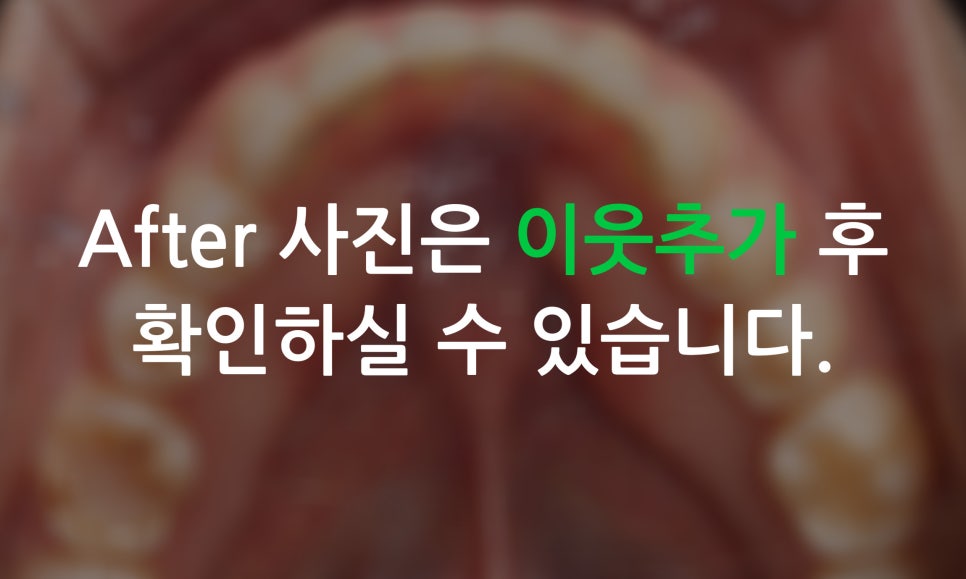 2D치과(투디치과)가 소개하는 토끼앞니 2D교정방법! 관련 이미지 10