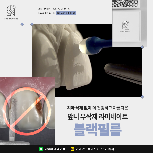 치아 삭제 없는 앞니 무삭제 라미네이트 <블랙필름> 관련 이미지 1