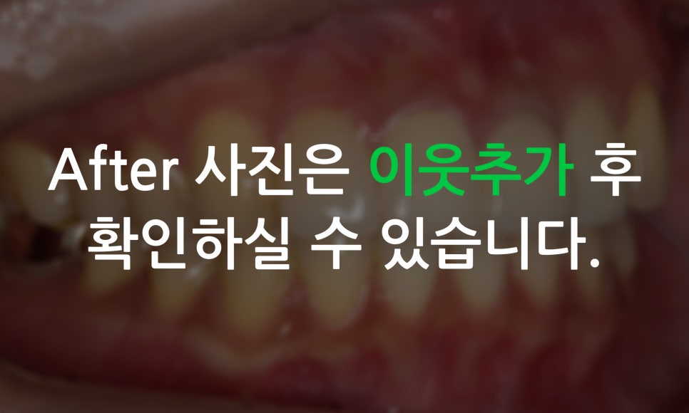 토끼앞니교정, PFM크라운 재보철을 동시에 치료하는 방법? 관련 이미지 12