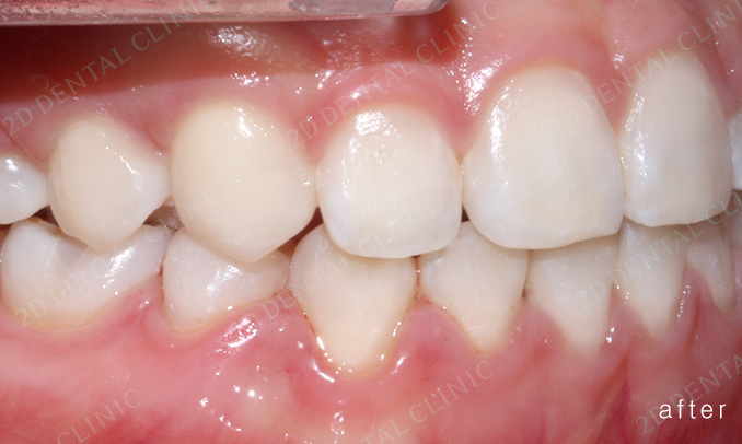 우디의 교정 일기ㅣ부정 교합 치아교정 후기 관련 이미지 7