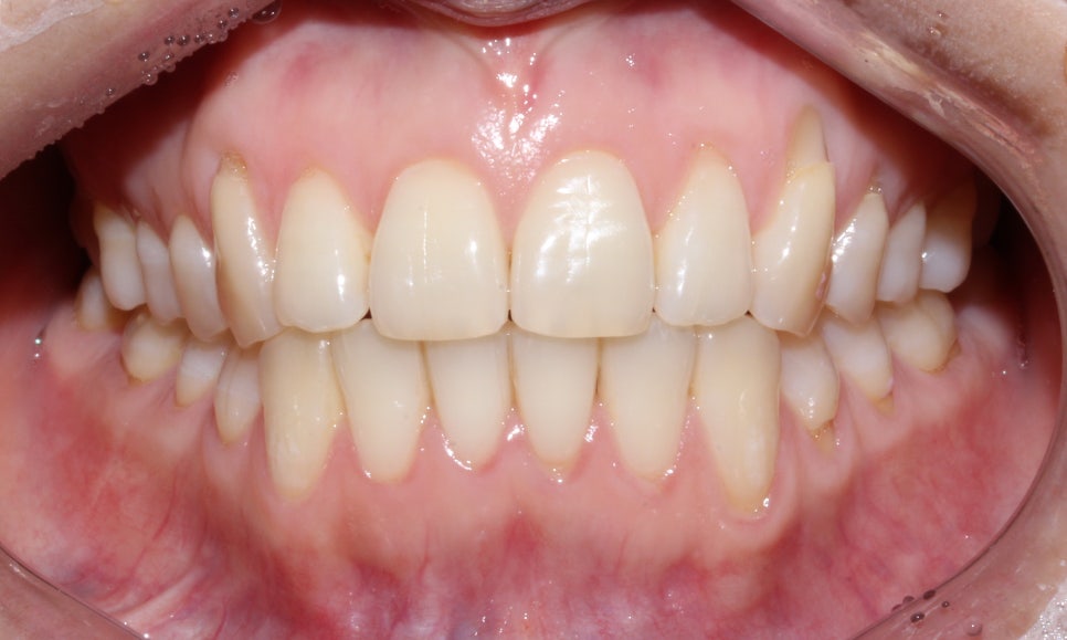 안 보이는 교정!2D교정 잘하는 강남 신논현 근처 2D치과! 관련 이미지 11