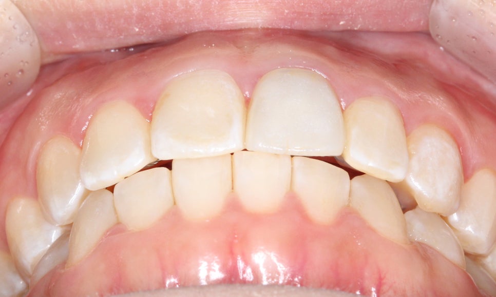 양악교정 송곳니교정 중심으로 관련 이미지 10