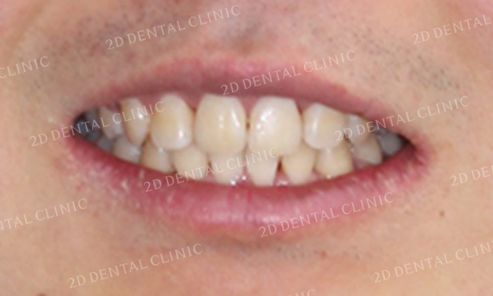 돌출앞니 교정, 튀어나온 입을 넣어보자! by.투디치과(2D치과) 관련 이미지 15