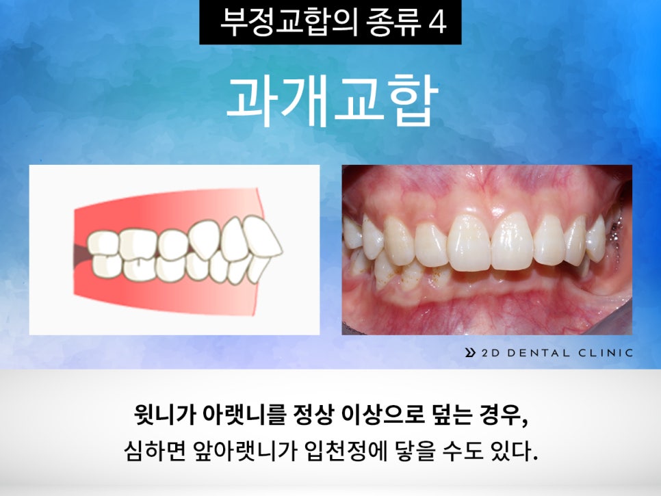 [교정상식] 부정교합 종류! 나는 어떤 케이스에 해당될까? 관련 이미지 7