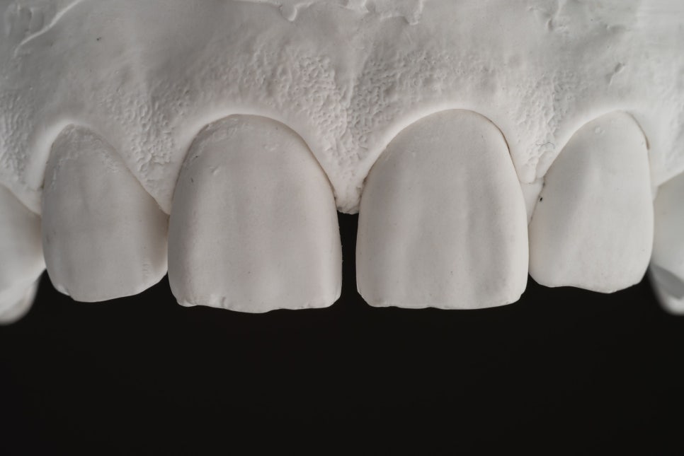 깨진 치아, 벌어진 치아 전부 관련 이미지 3