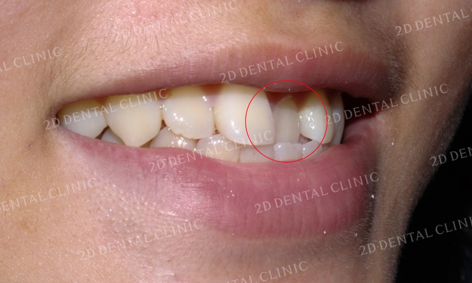 반대교합 치아교정, 앞니를 가지런하게! by.투디치과(2D치과) 관련 이미지 11