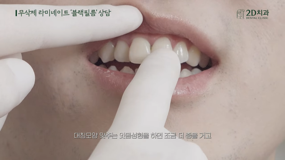 [블랙필름 상담받고 왔어요] #2 반대교합도 가능할까요? 관련 이미지 20