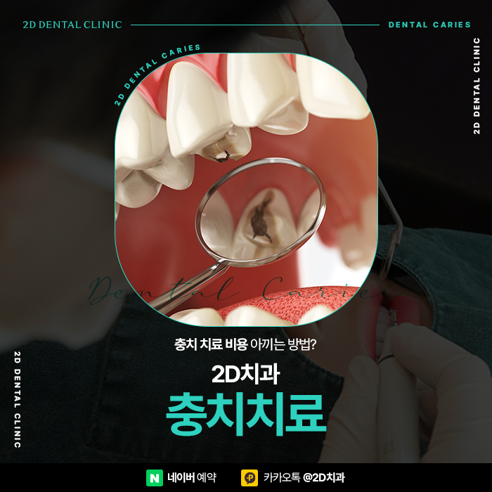 충치치료비용 아끼는 방법, 신논현 충치치료 잘하는 곳 관련 이미지 1