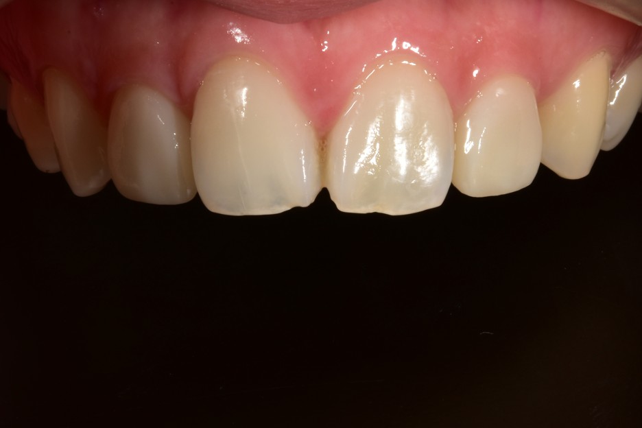 [투디치과] 블랙필름(비스포크) 치료의 다양한 사례 관련 이미지 20