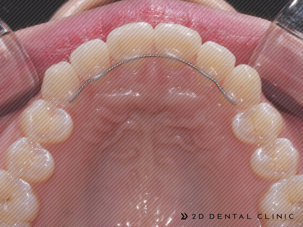 앞니 덧니 부분교정 케이스 전후비교, 교정전문 2D치과 관련 이미지 11