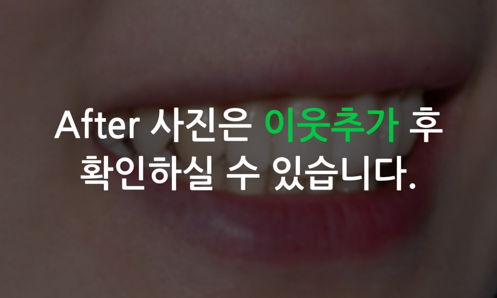 앞니틀어짐 2D교정으로 한번에 끝내는 방법! 관련 이미지 6