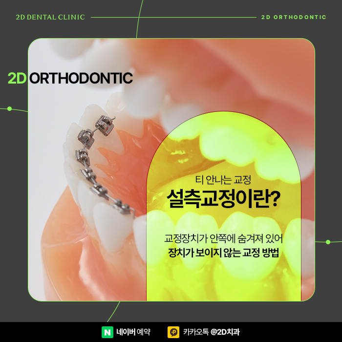 덧니부분교정 2D교정으로 해결, 강남 설측교정 관련 이미지 2